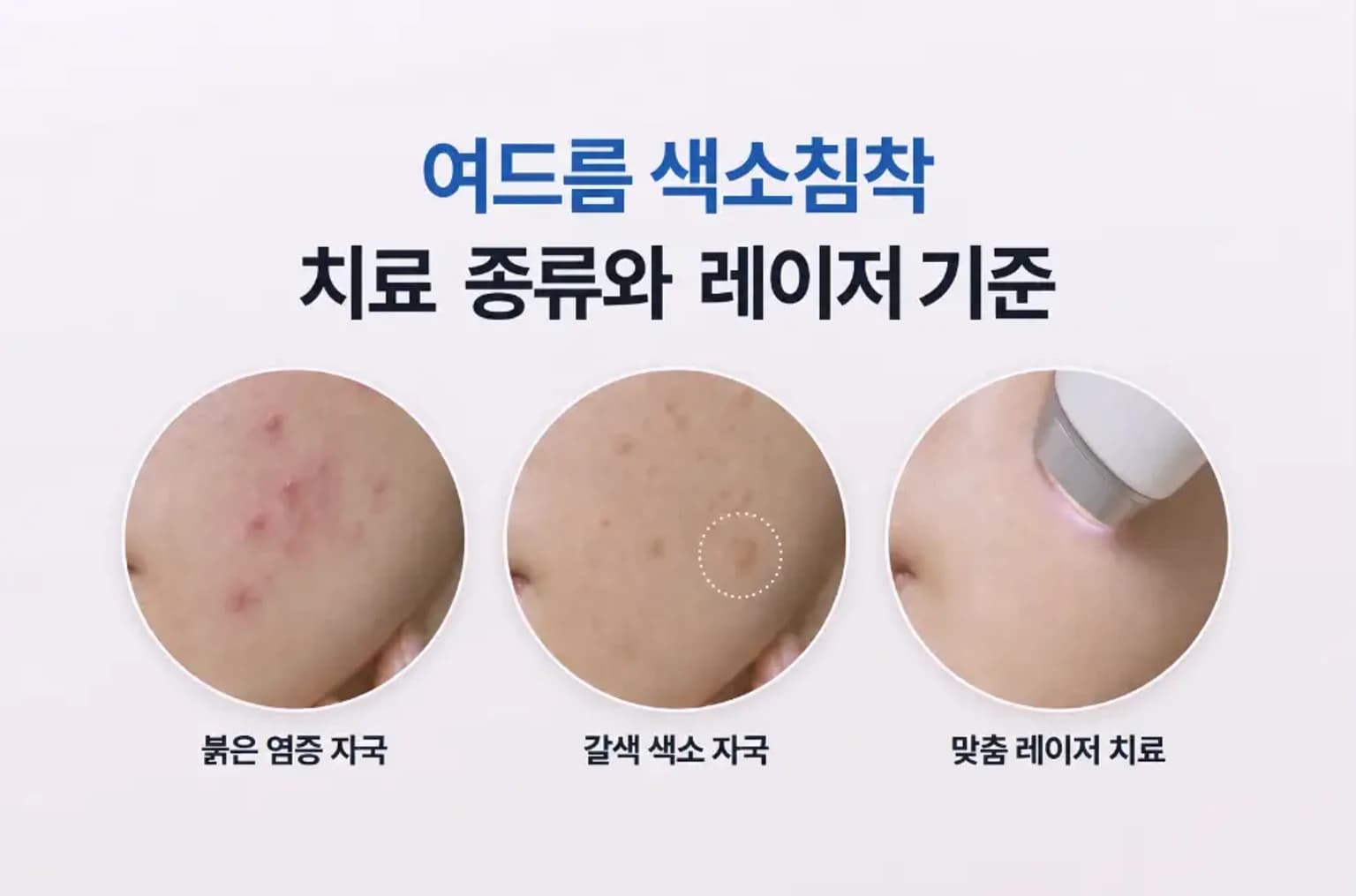염증 자국과 갈색 색소, 레이저 핸드피스 접촉 장면을 담은 여드름 색소침착 치료 썸네일